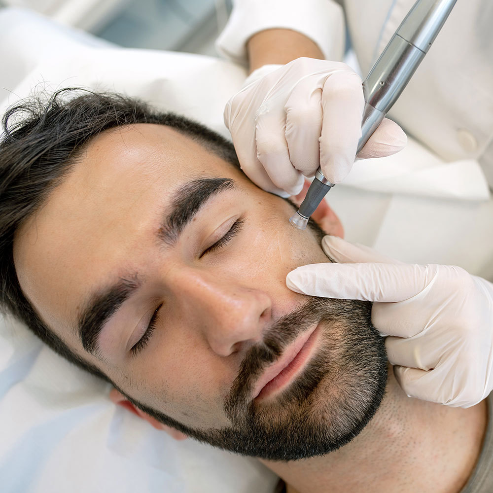 Microneedling on a Man